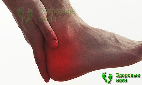 Пяточная шпора - симптомы и лечение в домашних условиях эффективными способами