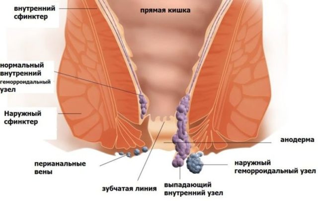 Как вправить геморроидальный узел самостоятельно пошаговая инструкция