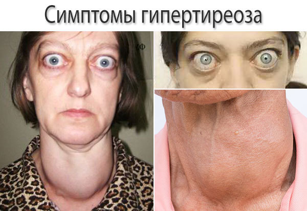 Гипертиреоз - причины, симптомы, диагностика и лечение