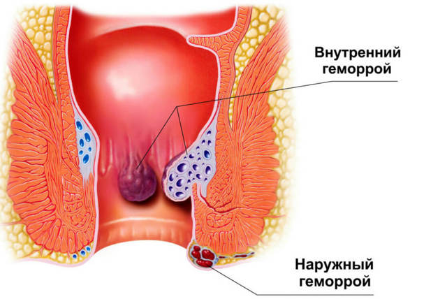 Гепариновая мазь от геморроя: инструкция по применению, цена, отзывы, аналоги