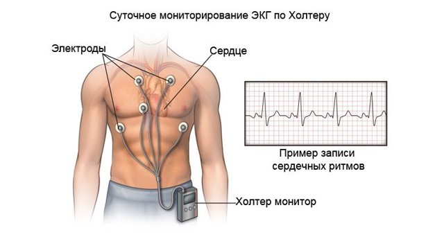 Холтеровское мониторирование экг что это такое — Сердце