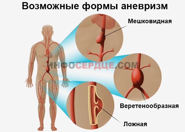 Аорта развернута что это значит. Аорта уплотнена и развернута что это
