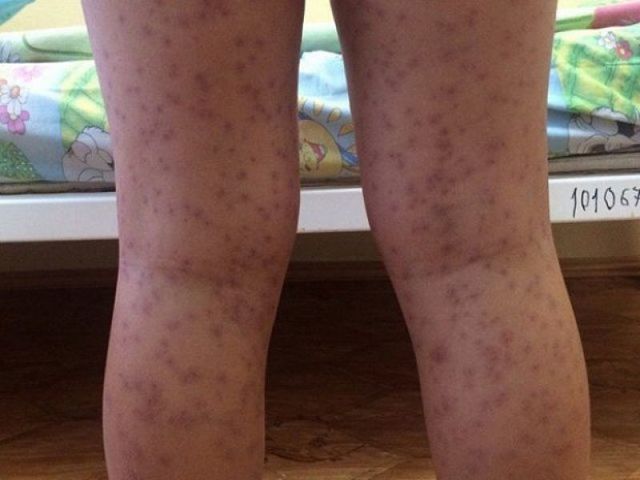 Идиопатическая тромбоцитопеническая пурпура.