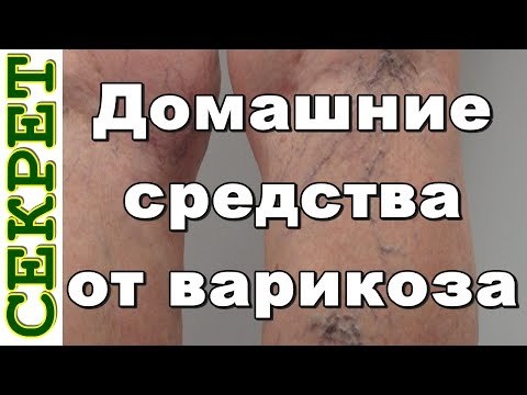 Вены на ногах лечение народными средствами, убрать варикоз за 7 дней