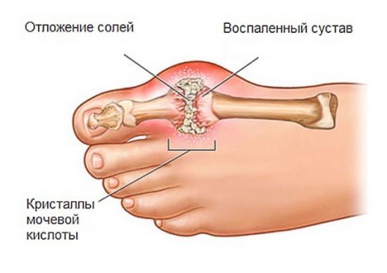 Мочевая кислота составляет уменя 755 что делать. Какая норма мочевой кислоты в крови мужчин, женщин и детей
