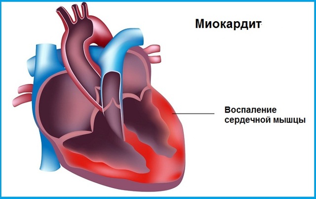 Покалывание в сердце: причины, симптомы и лечение