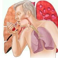 Кровь из горла при отхаркивании без кашля
