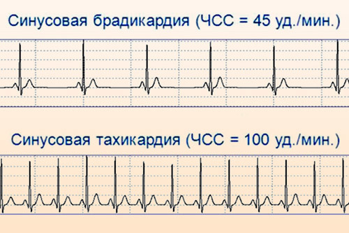 Синусовая аритмия сердца: что это такое, чем опасна, симптомы и экг