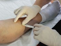 Склеротерапия вен нижних конечностей: плюсы и минусы