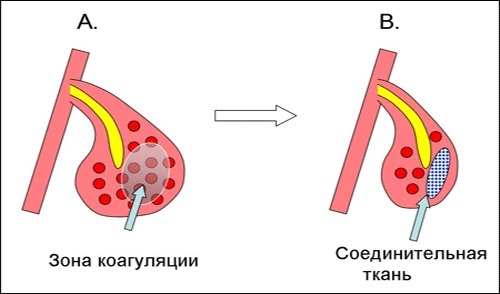 Как остановить кровотечение из носа в домашних условиях