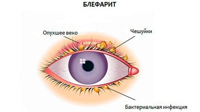 Красное пятно в глазу - причины и лечение