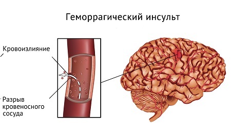 Геморрагический инсульт головного мозга: симптомы, последствия и лечение
