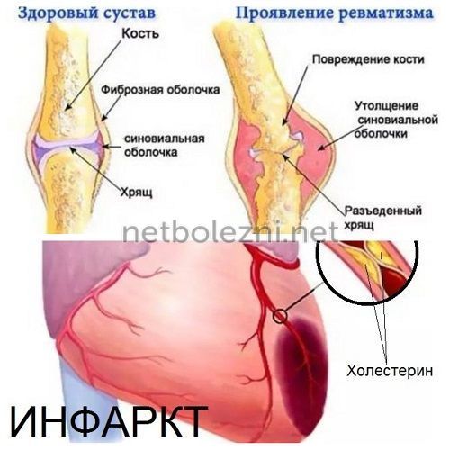 Сегментоядерные нейтрофилы понижены