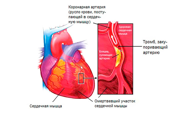Левожелудочковая недостаточность: симптомы, лечение