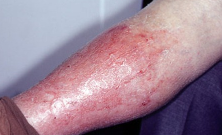 Нейродермит у взрослых и детей: симптомы (фото), лечение