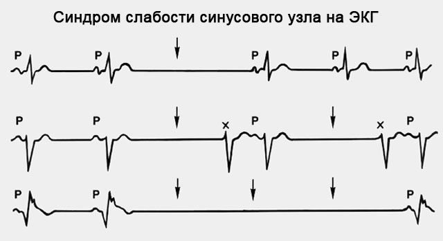 ЭКГ при синдроме слабости синусового узла (СССУ)