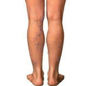 Болезни сосудов ног, лечение сосудов нижних конечностей