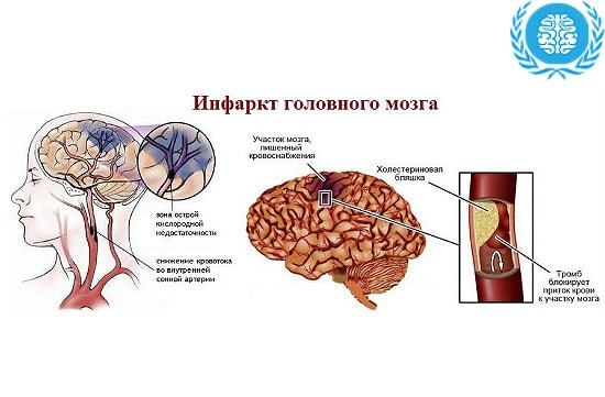 Инфаркт головного мозга - Мое Здоровье