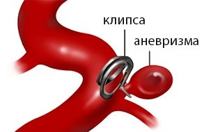 Клипирование аневризмы артерий головного мозга