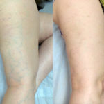 Осложнения и последствия после склеротерапии