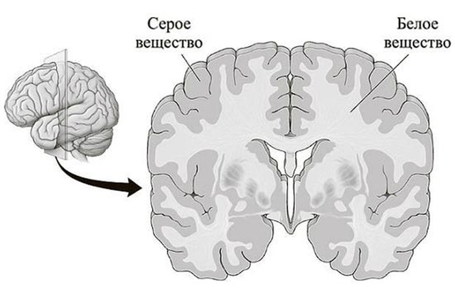 Единичные очаги в белом веществе головного мозга - результаты МРТ