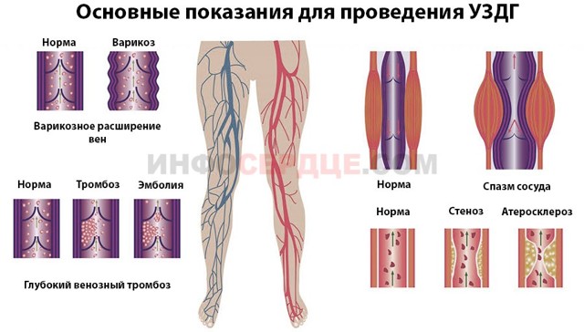 УЗДГ вен нижних конечностей (технологии 2019)