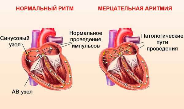 Ограничения после установка кардиостимулятора сердца, что противопоказано при электрокардиостимуляторе, противопоказания с ЭКС