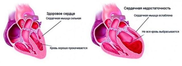 Чем опасна аритмия сердца