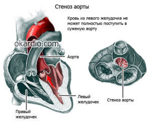 Аорта уплотнена что это значит — Сердце