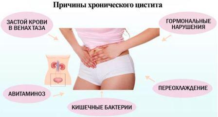 Острый цистит у женщин: симптомы и лечение