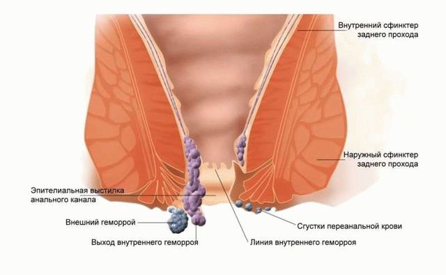 Какой врач лечит геморрой