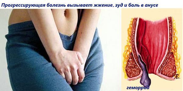 Гепариновая мазь от геморроя: инструкция по применению, цена, отзывы, аналоги