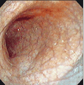 Хронический атрофический гастрит симптомы и лечение у взрослых