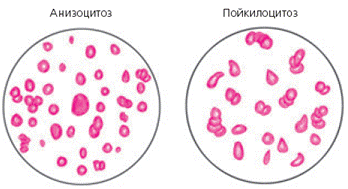 Анизоцитоз в общем анализе крови: что это, виды, причины