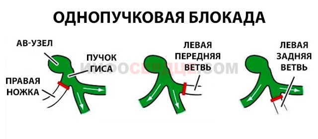 Неполная блокада левой ножки пучка Гиса - причины, лечение