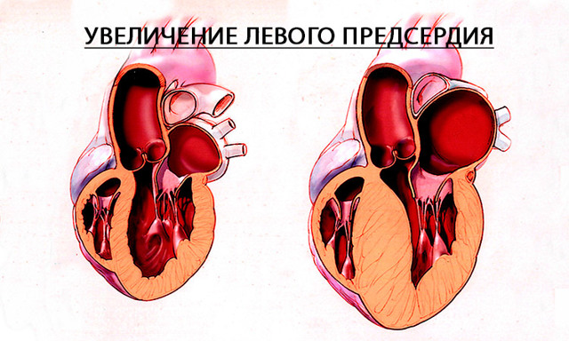 Левое предсердие увеличено что это значит — Сердце