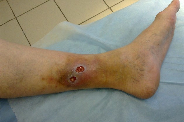 Трофические язвы нижних конечностей: виды, симптомы, лечение