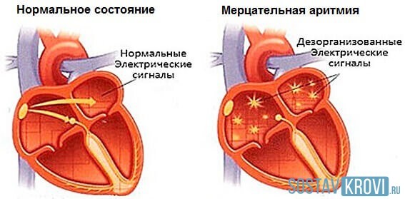 Что такое синдром Фредерика: суть, симптомы и лечение патологии. Синдром фредерика: что это, признаки, на экг, лечение