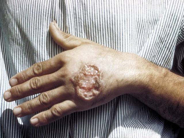 Трофическая язва - причины, симптомы, лечение, профилактика