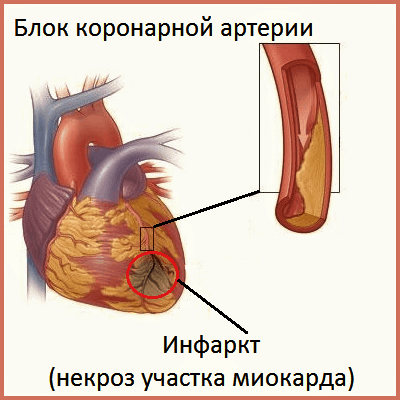 В каком месте и как болит сердце: признаки и симптомы
