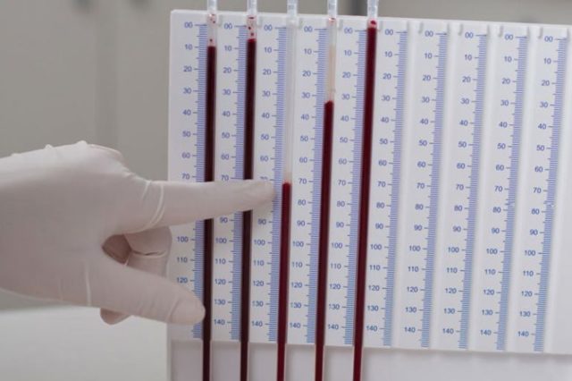 Где в организме человека происходит разрушение эритроцитов. Место образования эритроцитов. Строение эритроцитов. Место разрушения эритроцитов