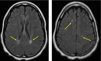 Лейкоэнцефалопатия головного мозга что это такое