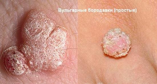 Что такое бородавка и как с ней бороться?