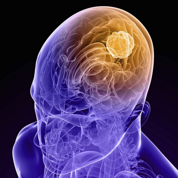 Киста сосудистого сплетения головного мозга: возникновение, диагностика, лечение. Опасна ли киста сосудистого сплетения для новорожденного?