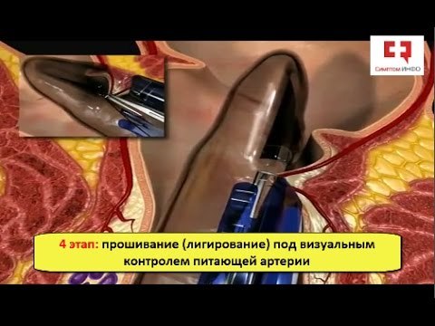Лечение геморроя без операции: эффективные методы