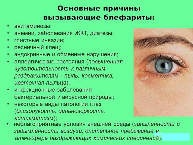 Блефарит – причины, симптомы и лечение блефарита век (фото)