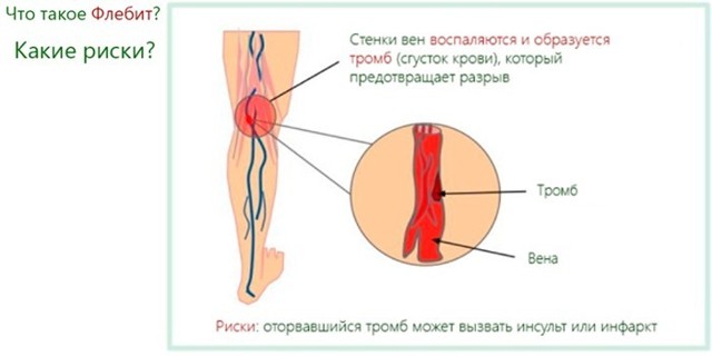 Флебит - что это такое, причины, симптомы, лечение