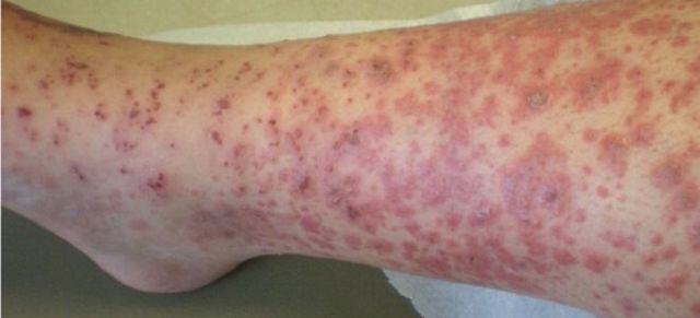 Васкулит мозга