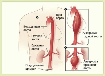 Аневризма грудного отдела аорты: диагностика и лечение