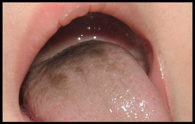 Коричневый налет на языке